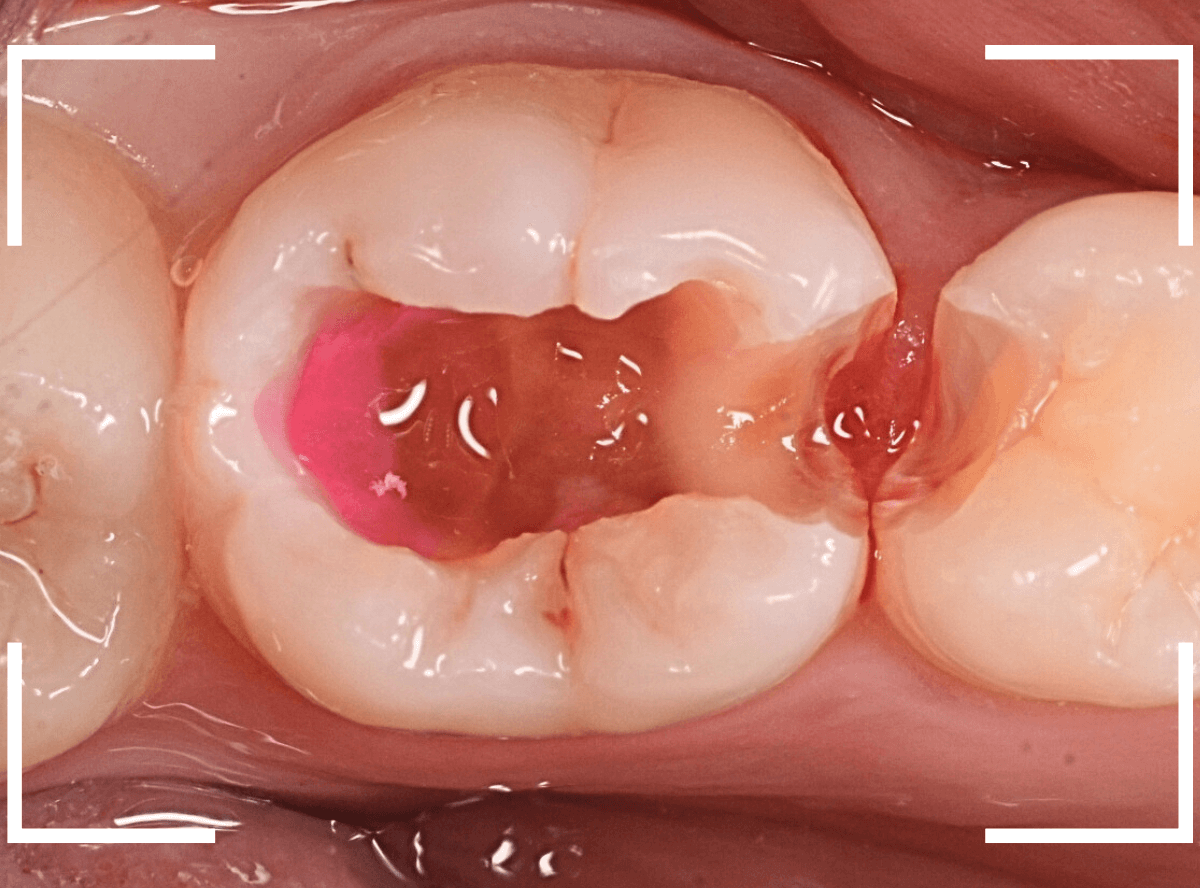 小窩裂溝う蝕1-6