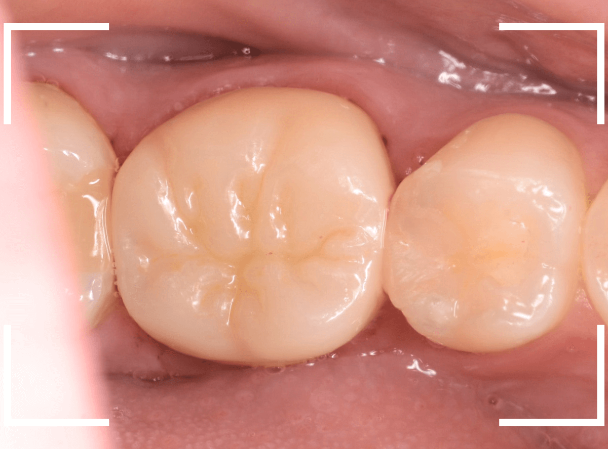 セラミック治療(クラウン・奥歯)9-6