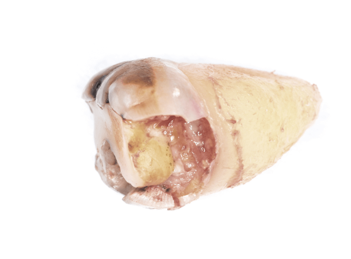 おやしらずの抜歯15-3