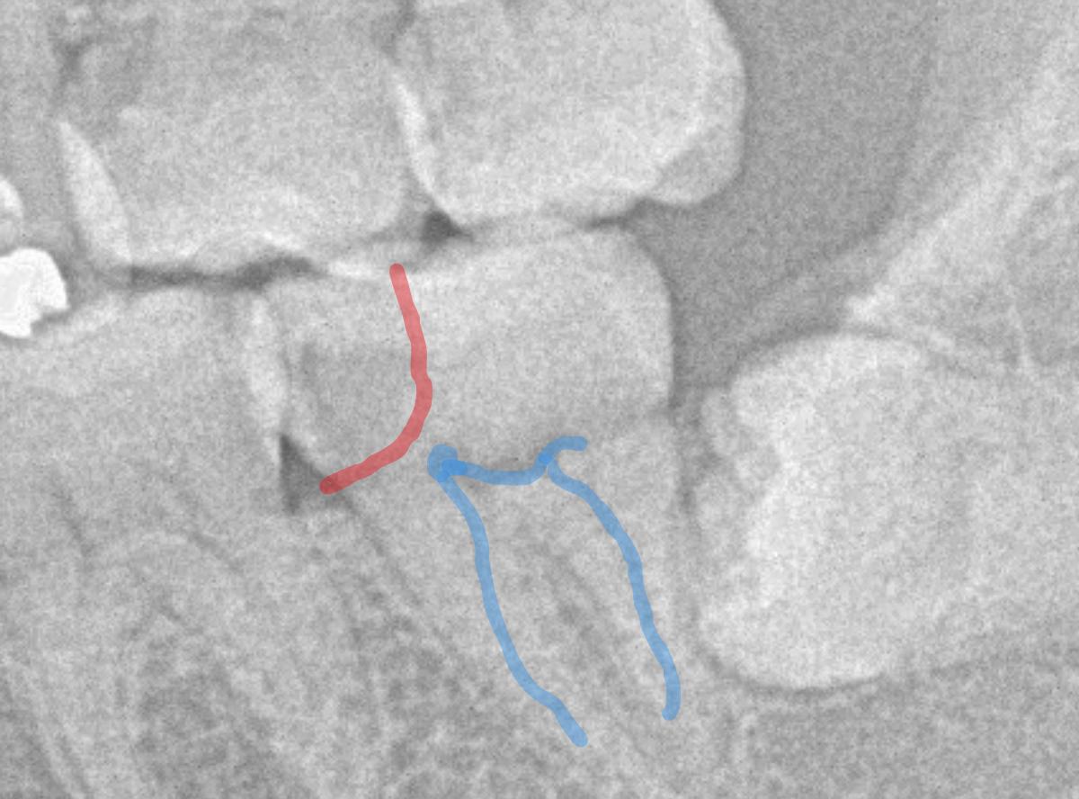つめものの下の深い虫歯(画像)3-3