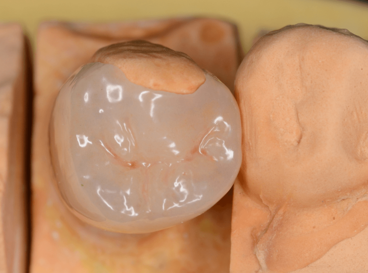 セラミック治療(インレー)14-2