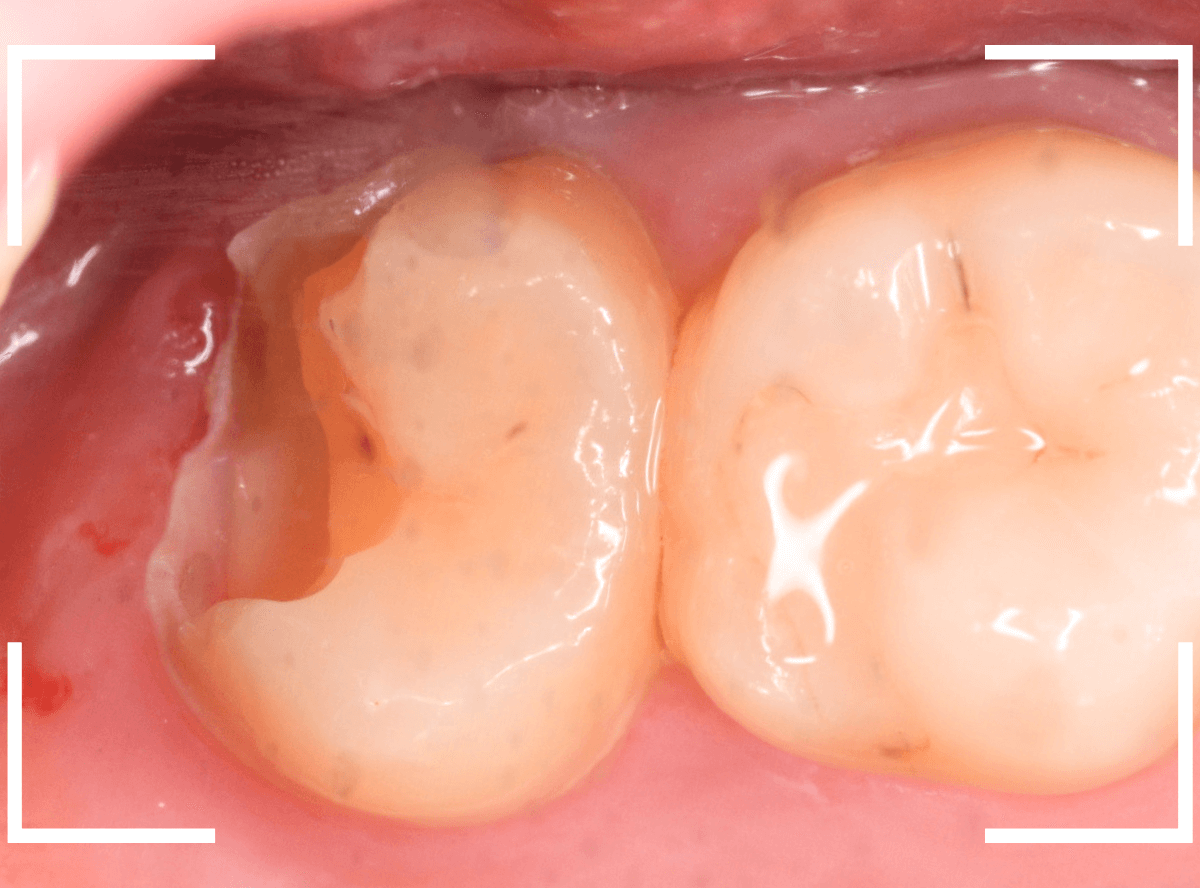 気づかないうちに深い虫歯3-6