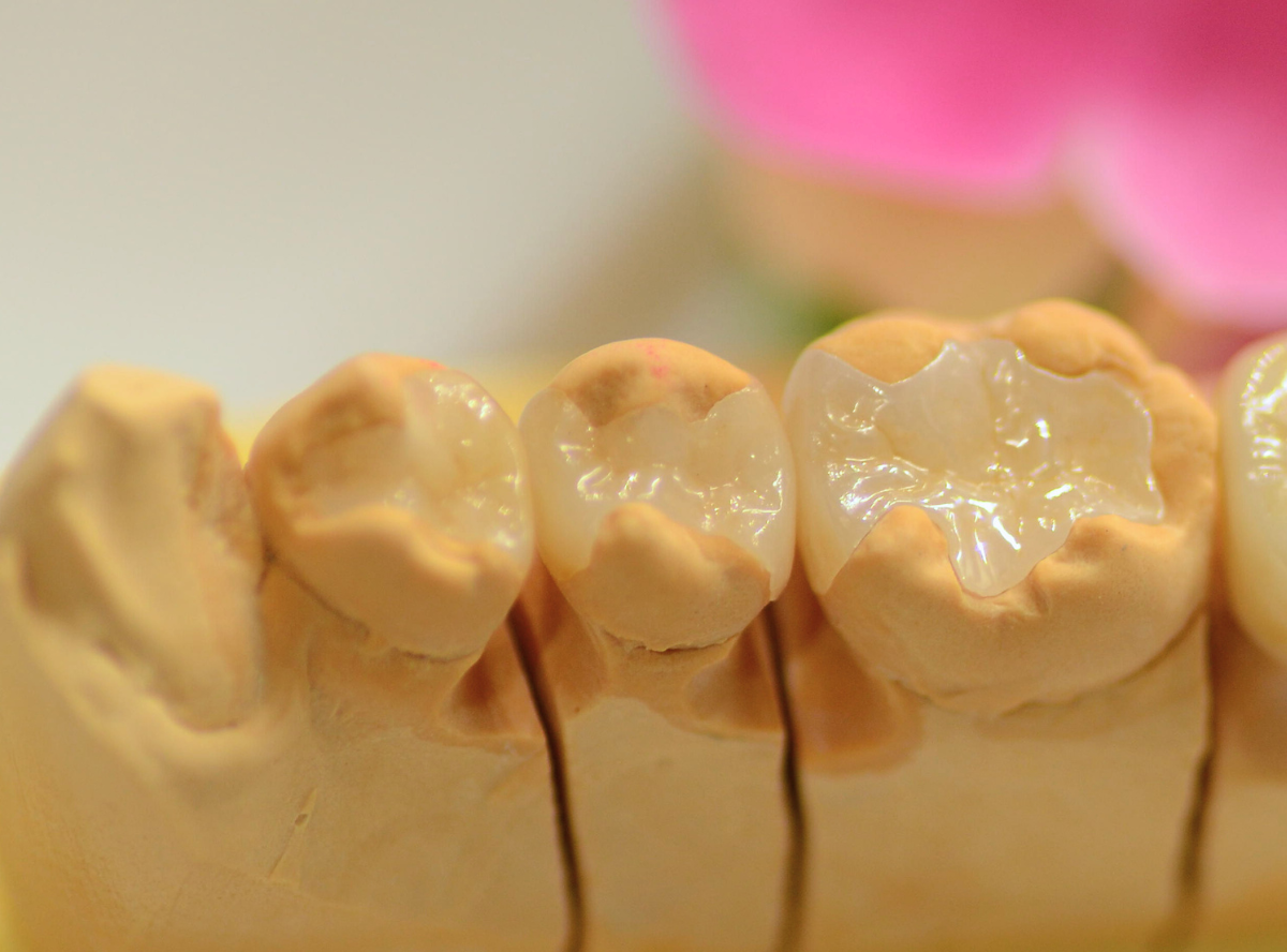 セラミック治療(インレー)4-2