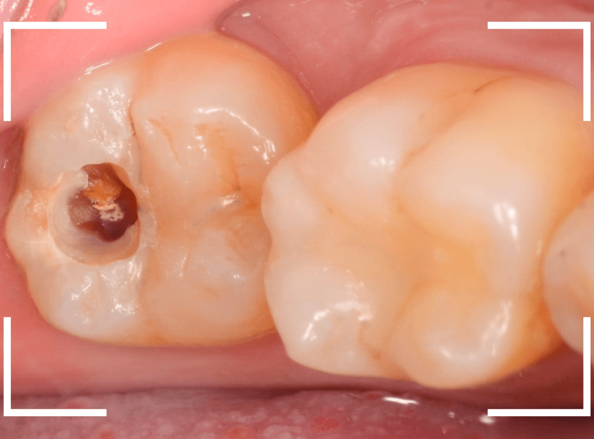 つめものの下の深い深い虫歯19-3