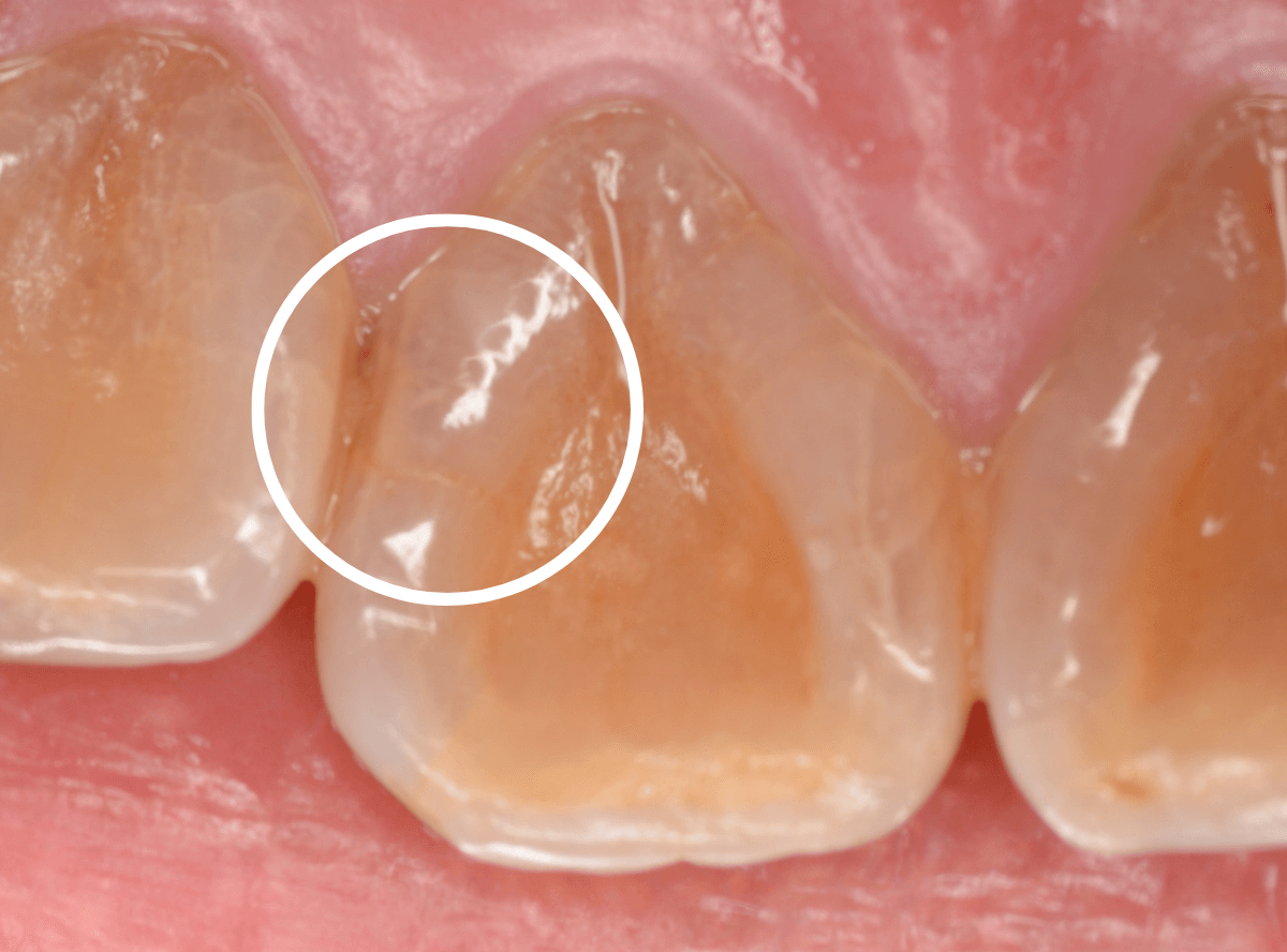 コンポジットレジン治療5-1