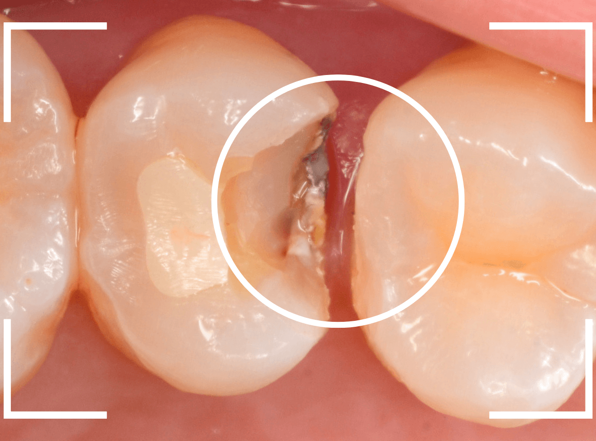 セラミック治療(インレー)27-3