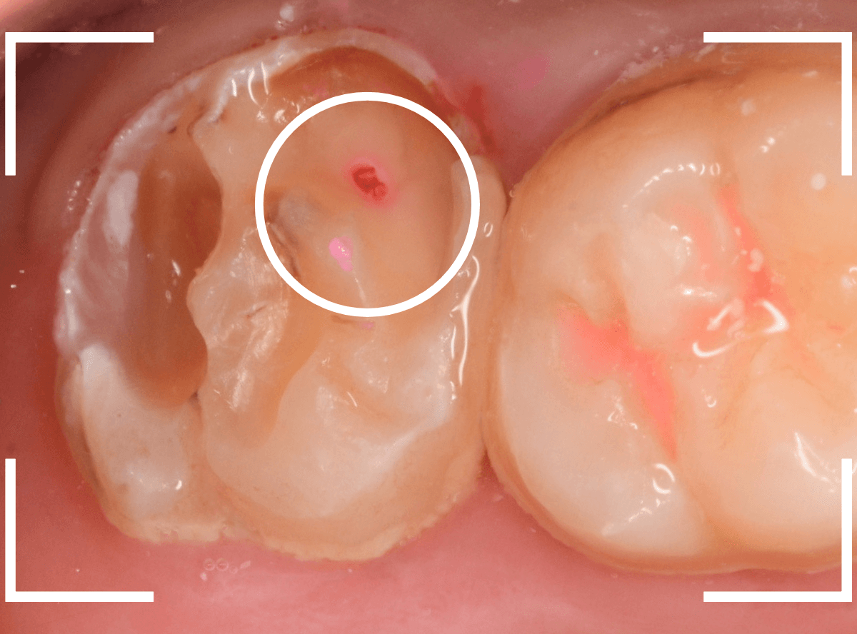 気づかないうちに深い虫歯6-4