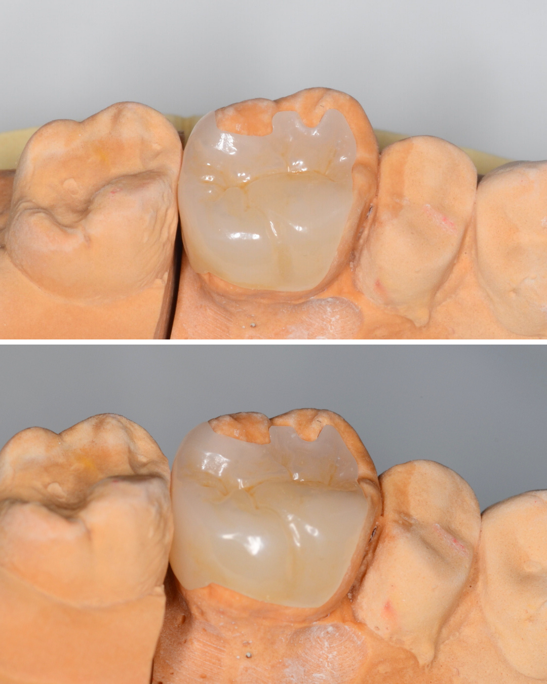 セラミック治療(インレー)2-2