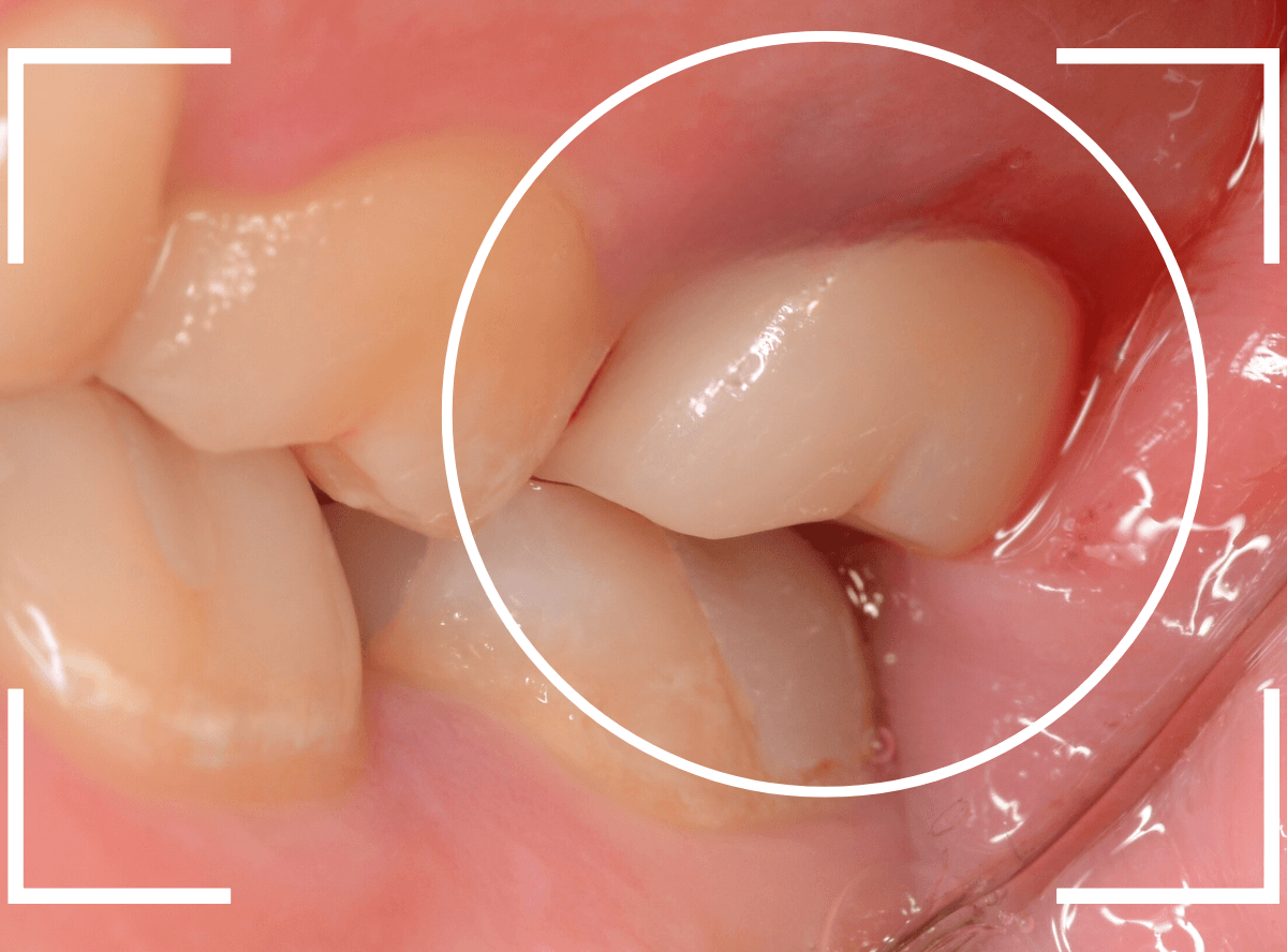 セラミック治療(クラウン・奥歯)10-8