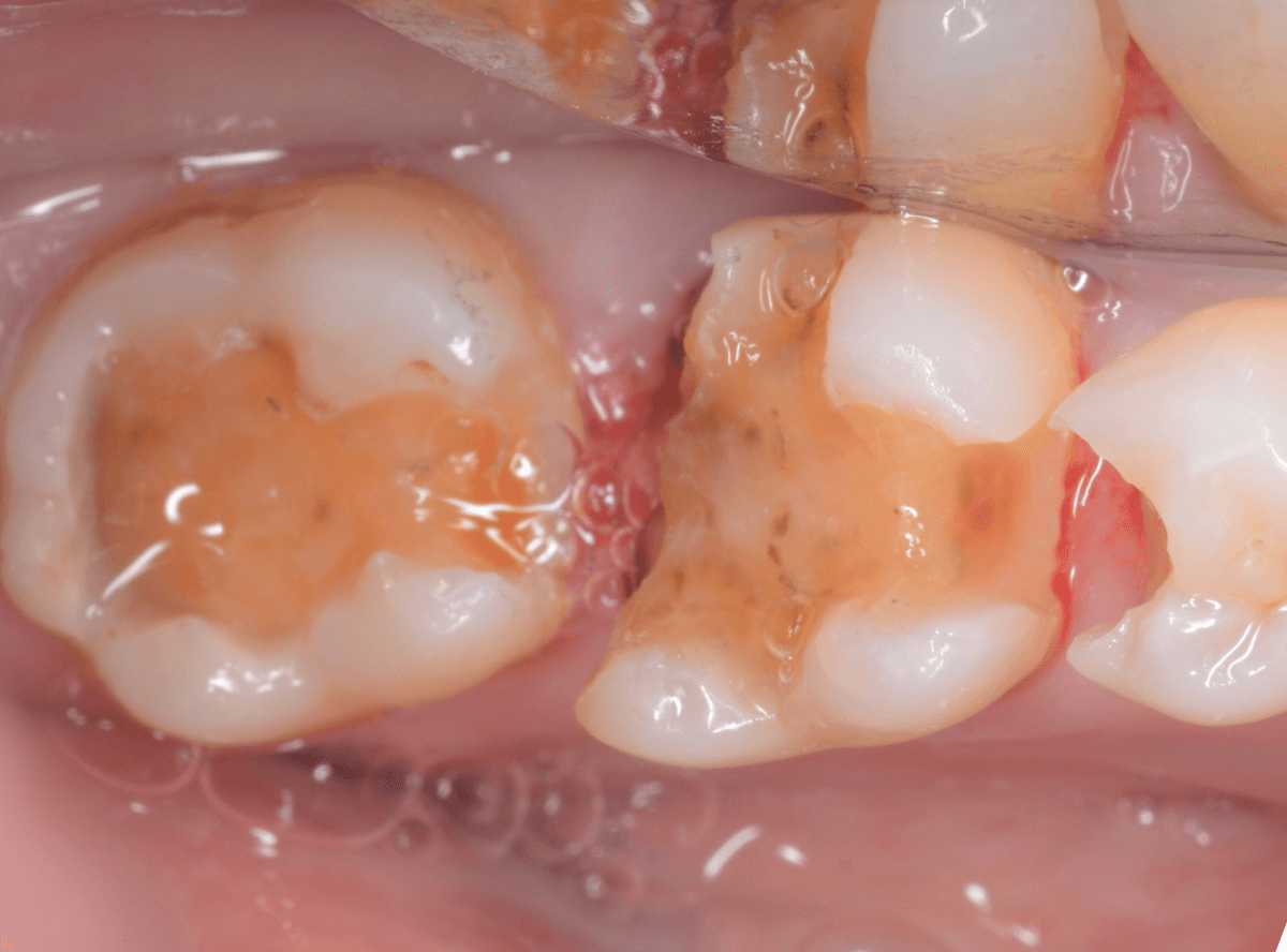 セラミック治療(インレー)8-4