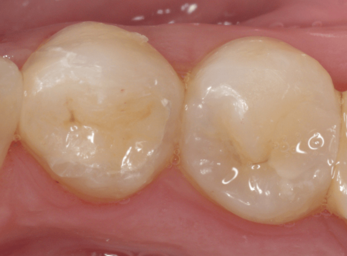 セラミック治療(インレー)13-4