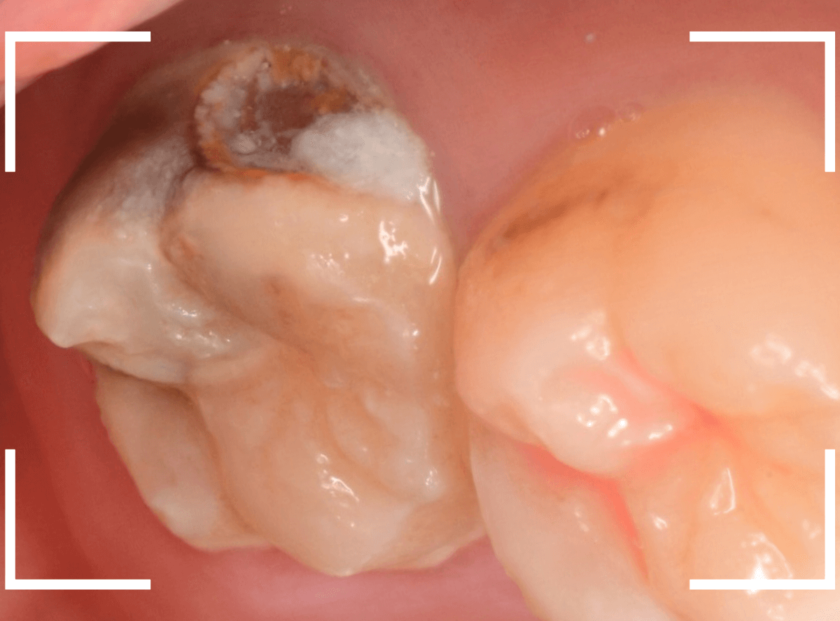 気づかないうちに深い虫歯6-2