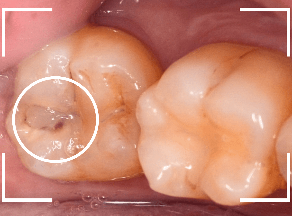 つめものの下の深い深い虫歯19-1
