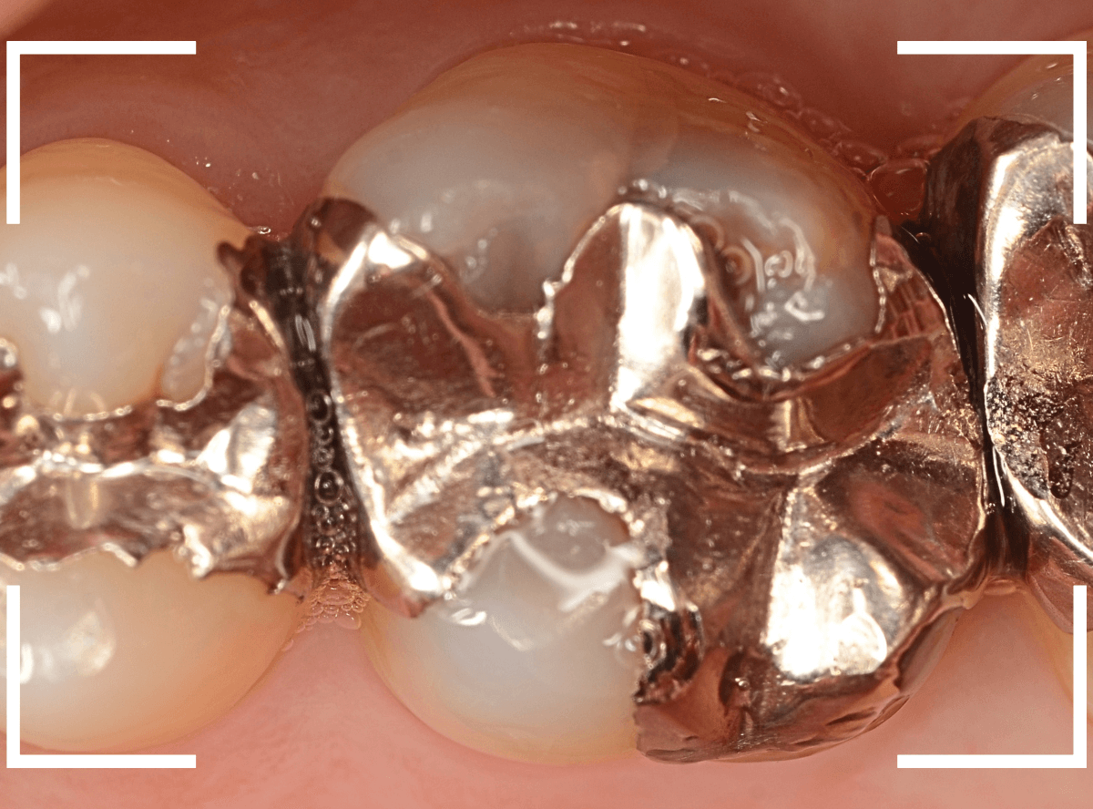 つめものの下の深い虫歯(画像)10-1