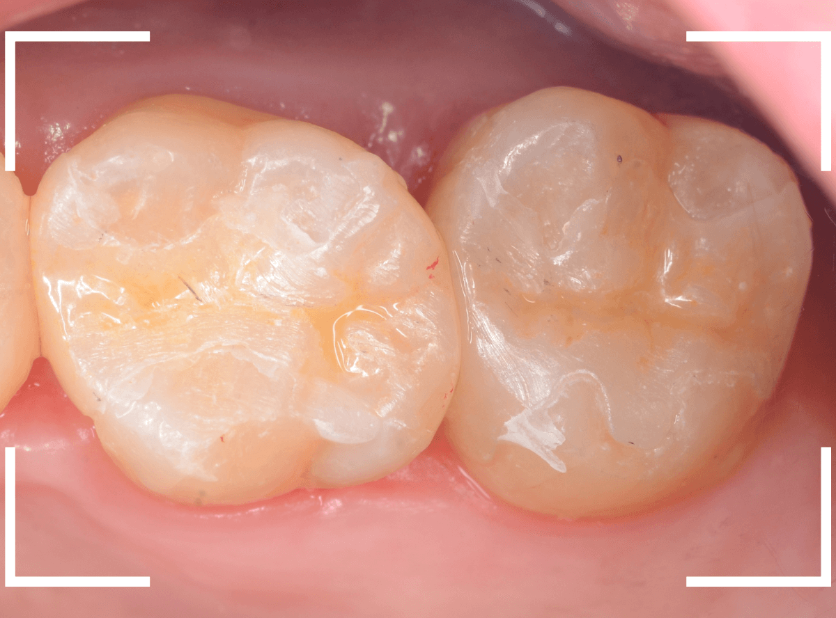セラミック治療(インレー)31-4