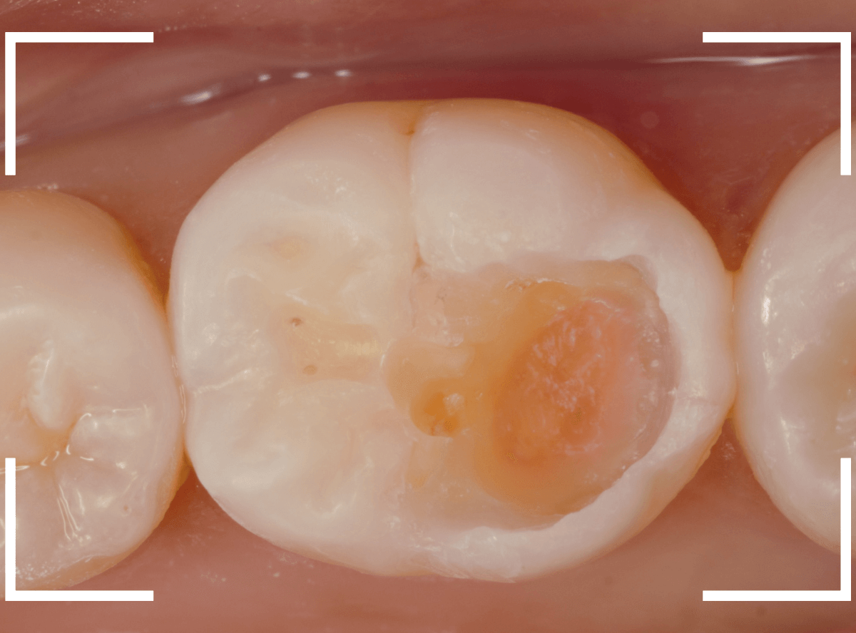 レントゲンでわかりづらい虫歯18-5