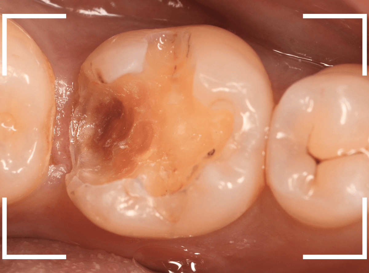 つめものの下の深い虫歯(画像)10-1