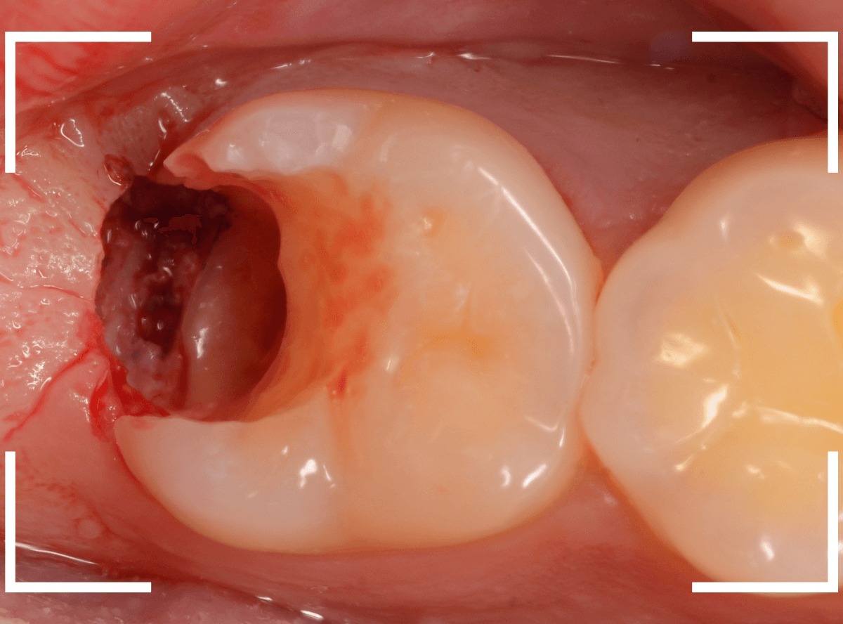 気づかないうちに深い虫歯12-6