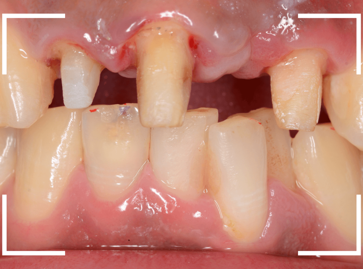 セラミック治療(前歯・クラウン)4-3