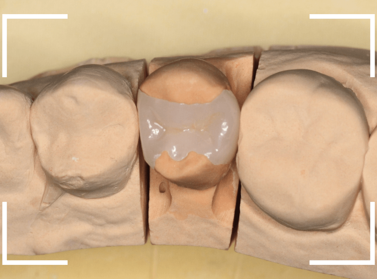 セラミック治療(インレー)22-3