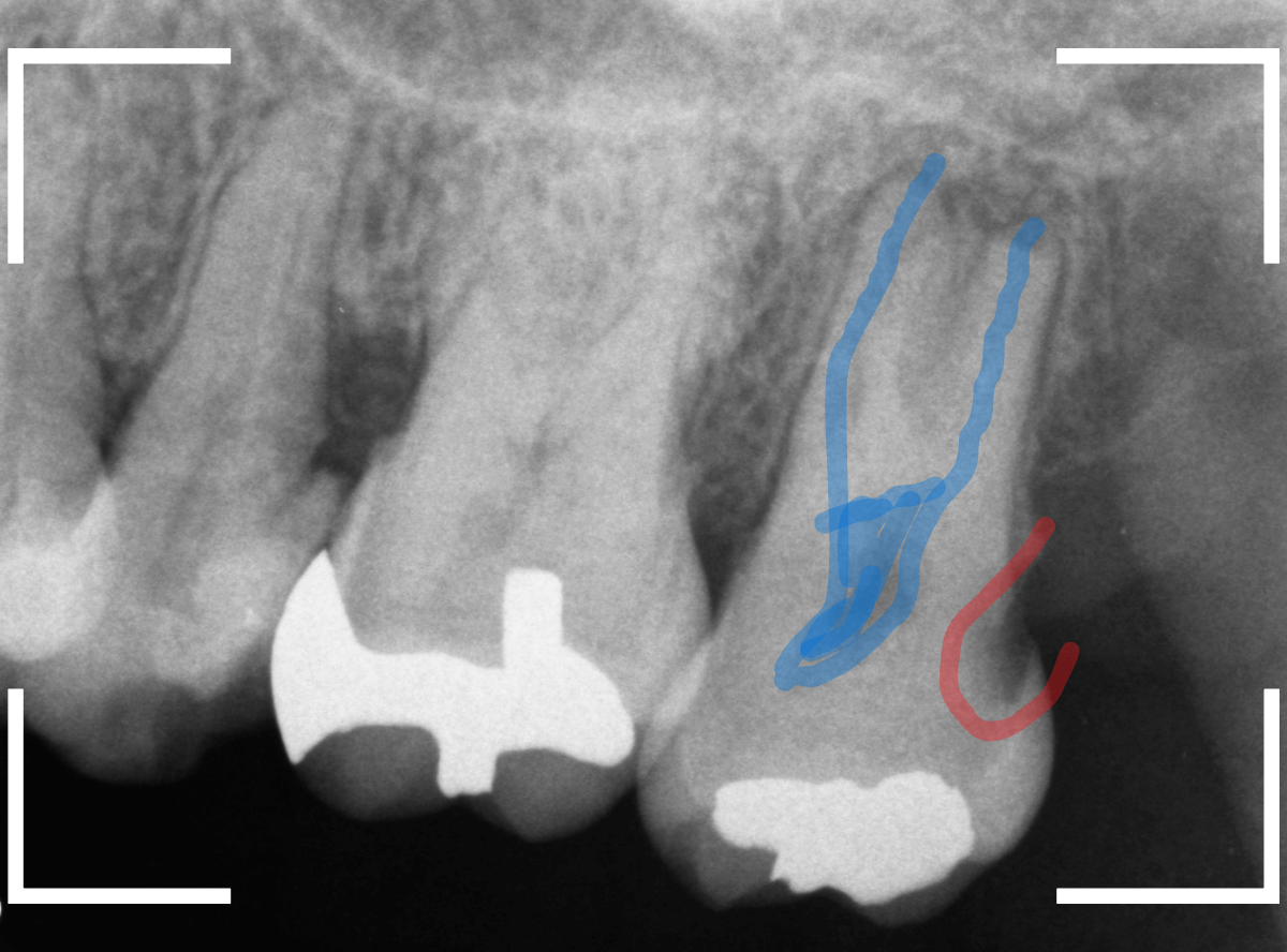 気づかないうちに深い虫歯18-4