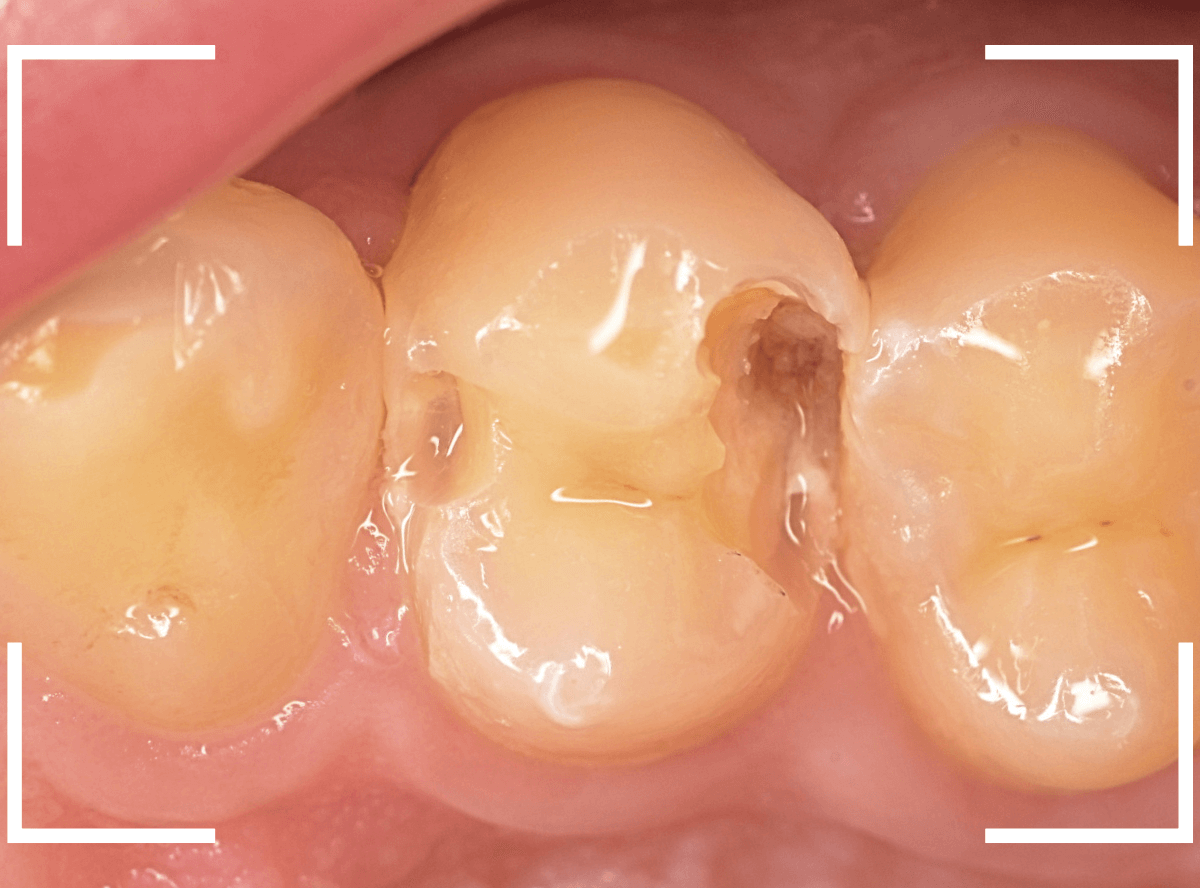 歯と歯の間の虫歯19-3