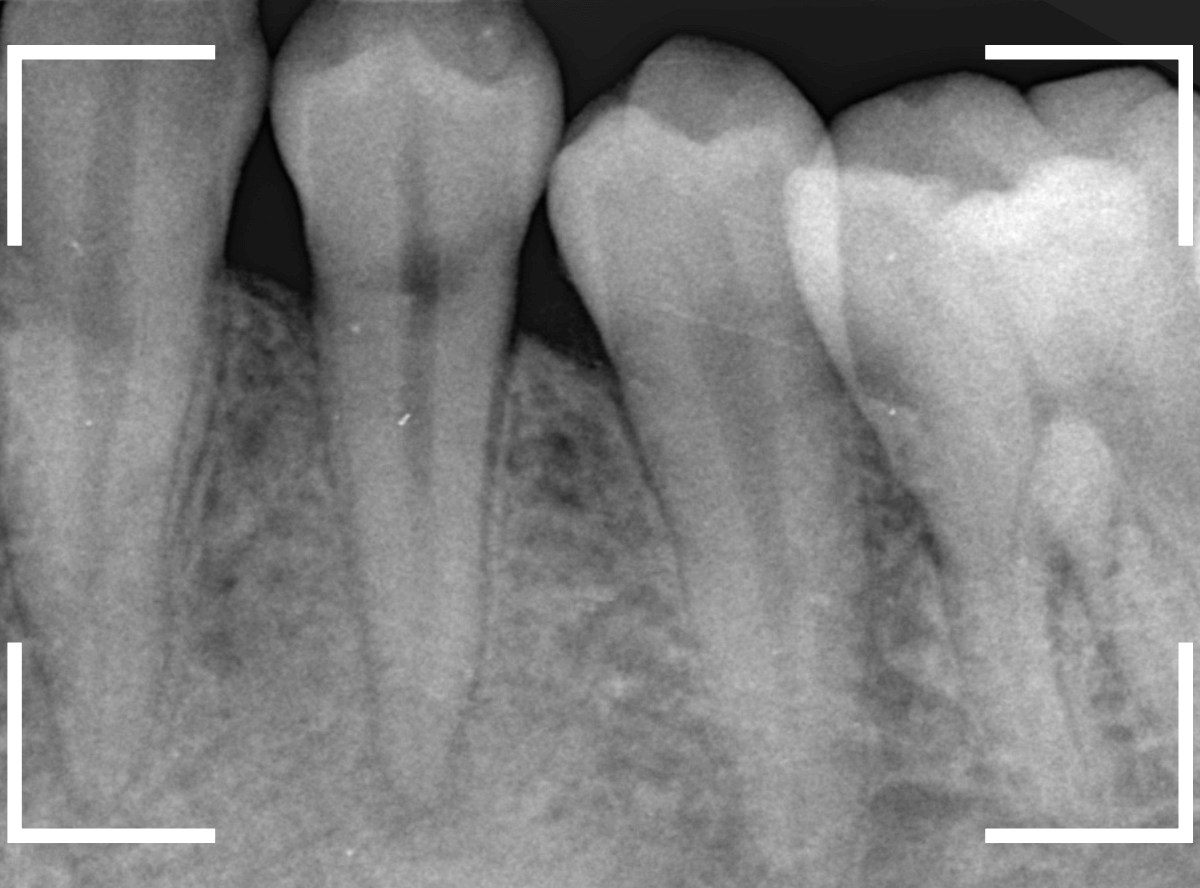 歯頚部う蝕の治療2