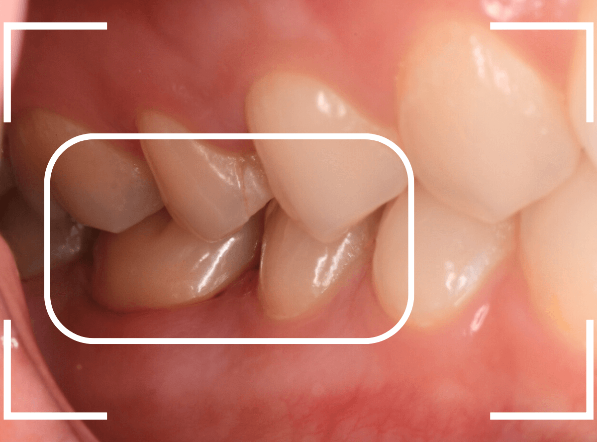 セラミック治療(クラウン・奥歯)9-7
