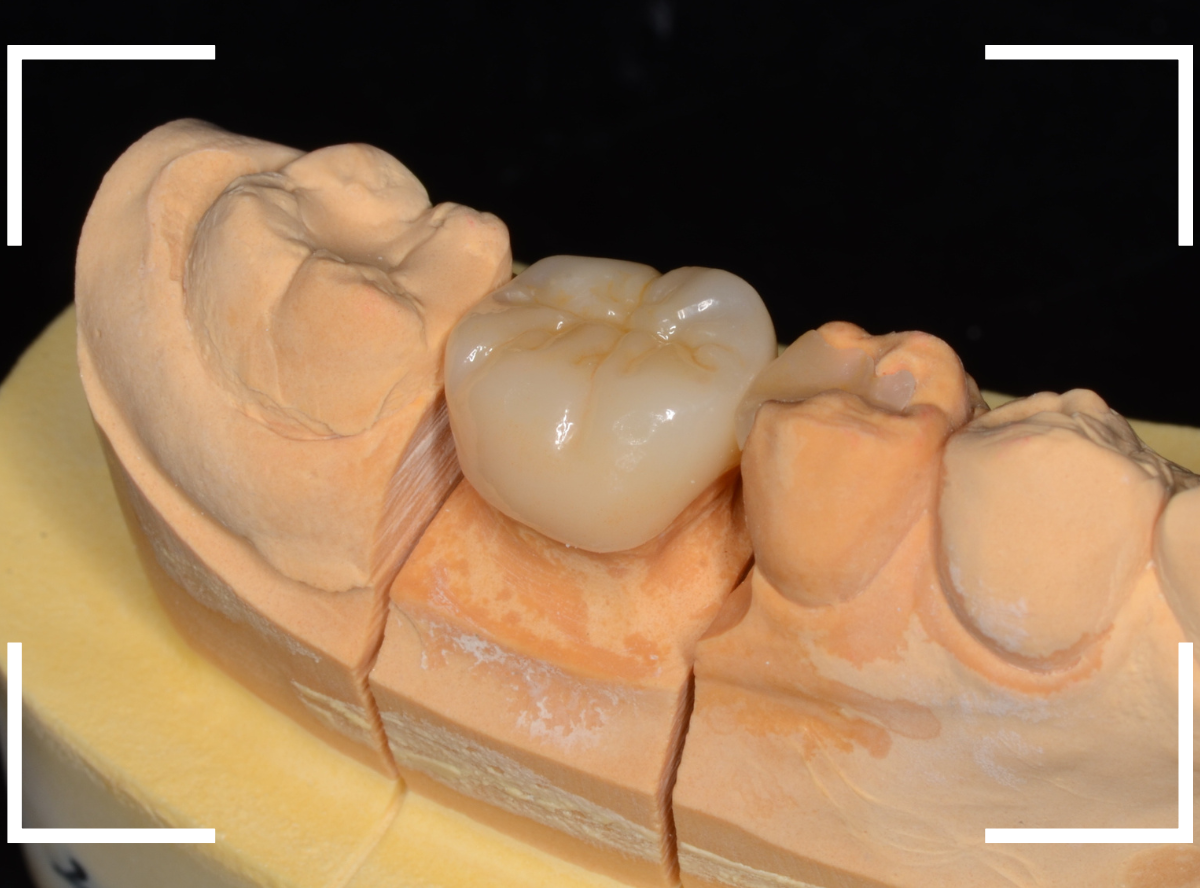 セラミック治療(クラウン・奥歯)9-5
