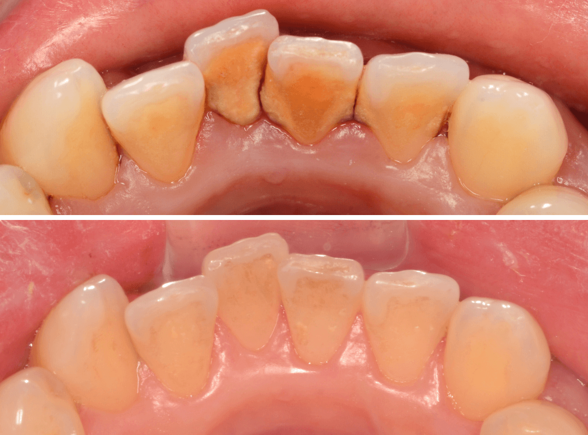 歯肉の中の歯石（歯肉縁下歯石）除去(画像）4-5