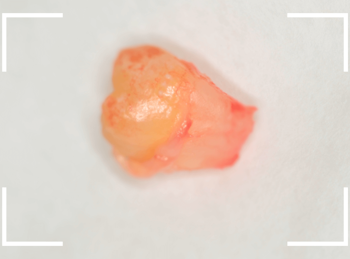 おやしらずの抜歯23-1
