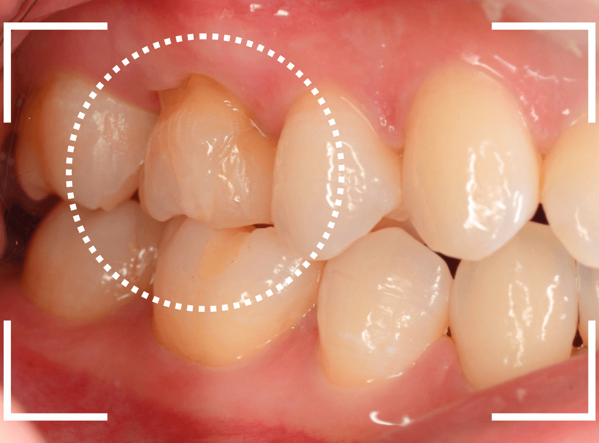 セラミック治療(インレー)35-5