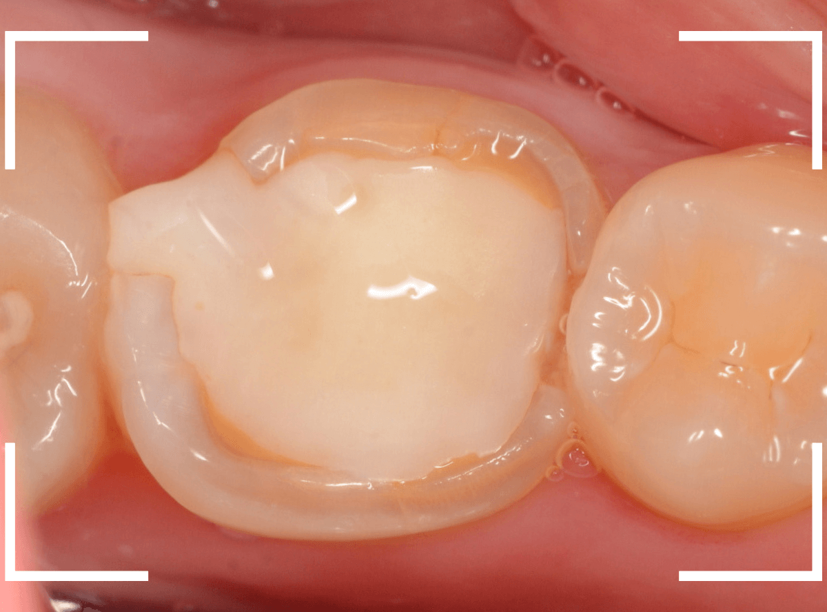 セラミック治療(クラウン・奥歯)15-1