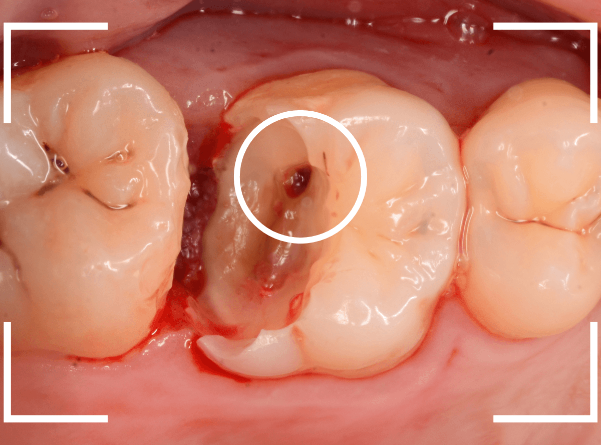 つめものの下の深い深い虫歯20-1