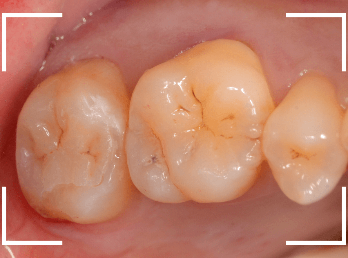 セラミック治療(インレー)30-1
