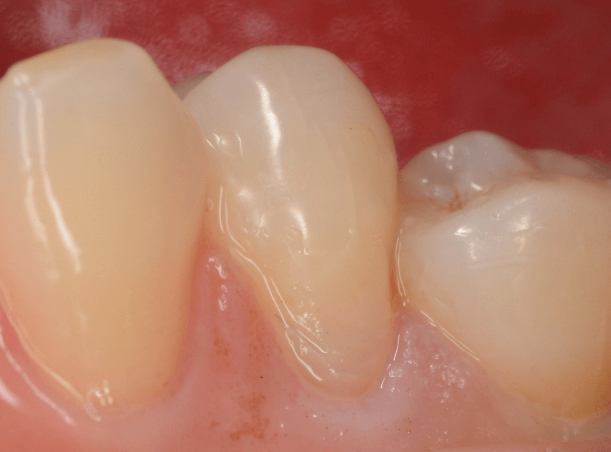 知覚過敏の画像5-3