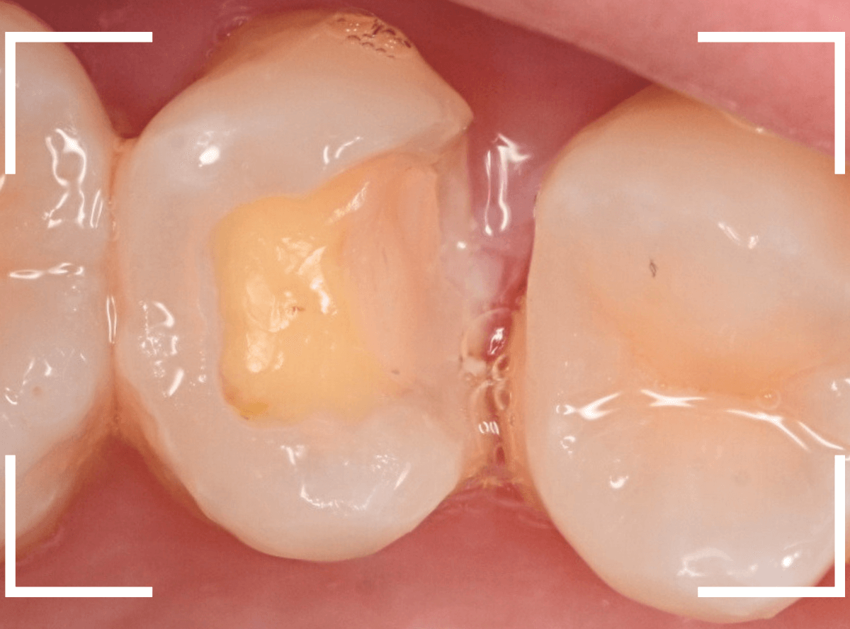 セラミック治療(インレー)27-6
