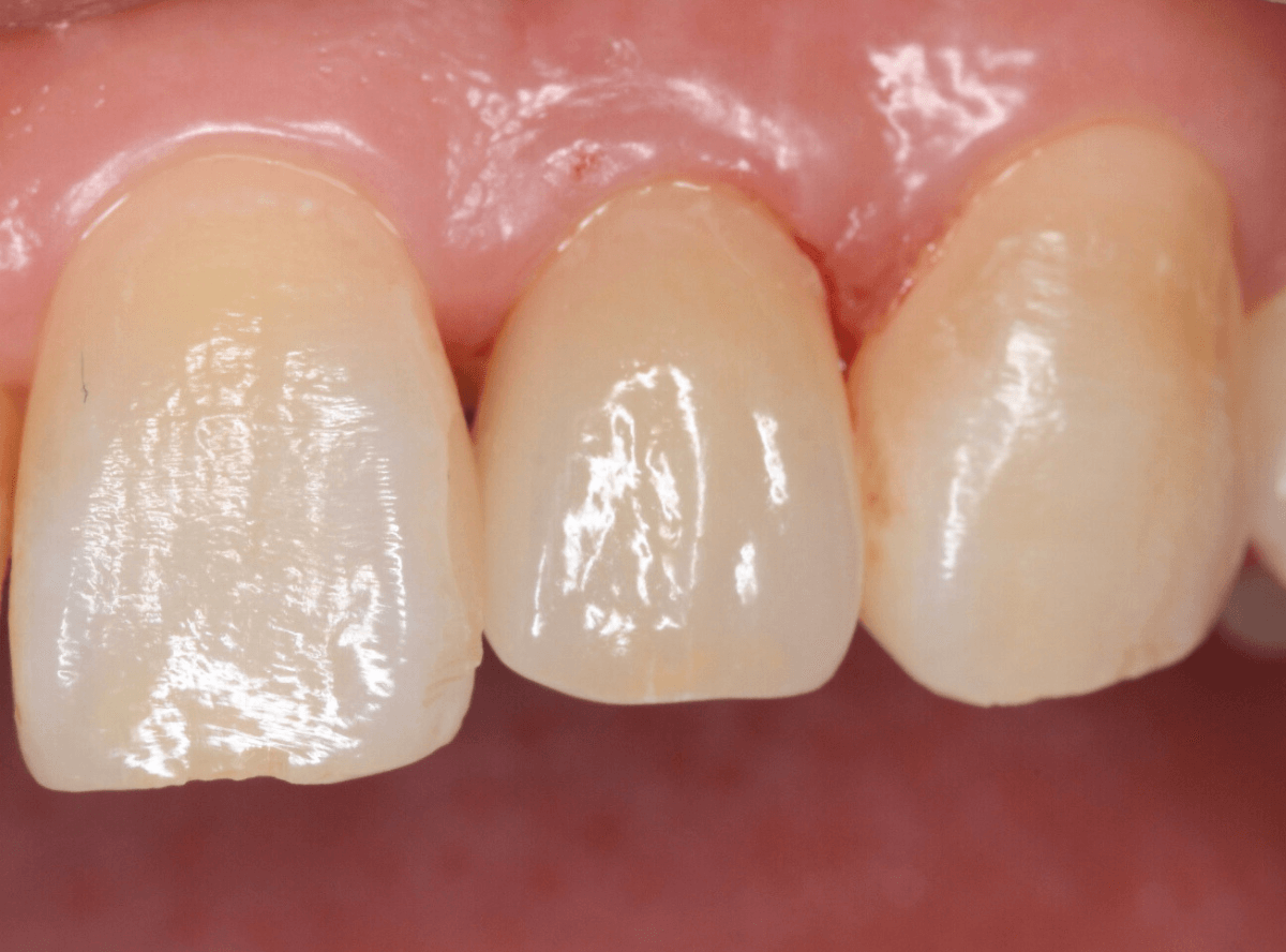 「前歯が折れた」という患者さん-6