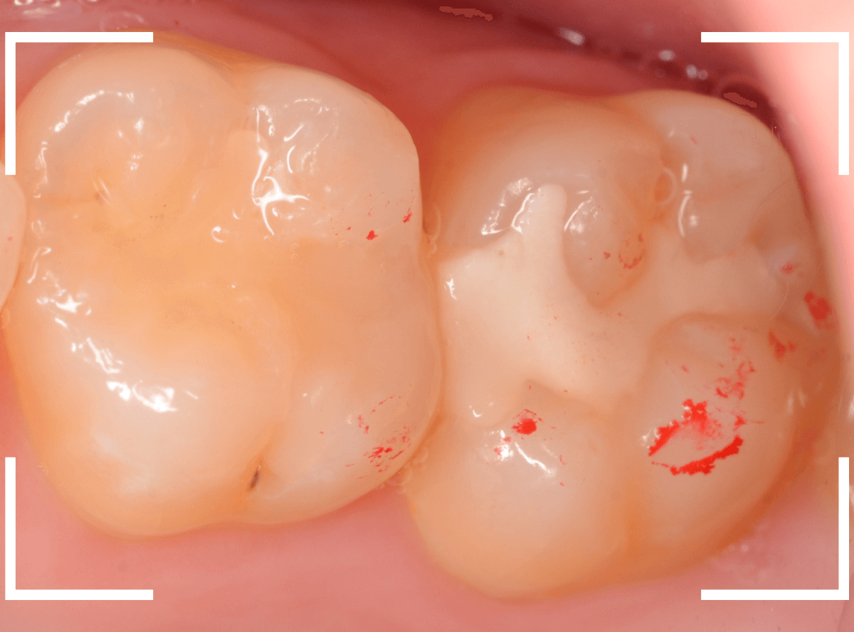 セラミック治療(インレー)29-1