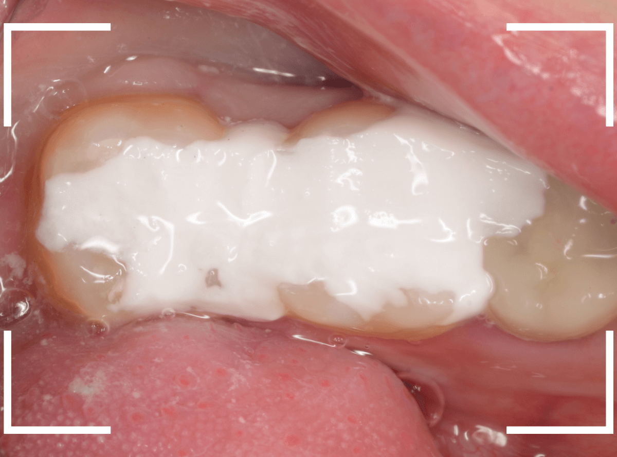 歯と歯の間の虫歯18-7