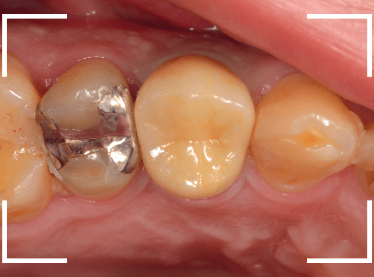 セラミック治療(クラウン・奥歯)14-1