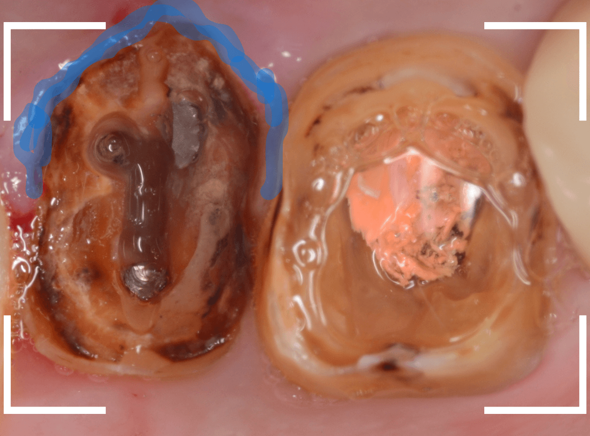 歯の土台の再治療3-8