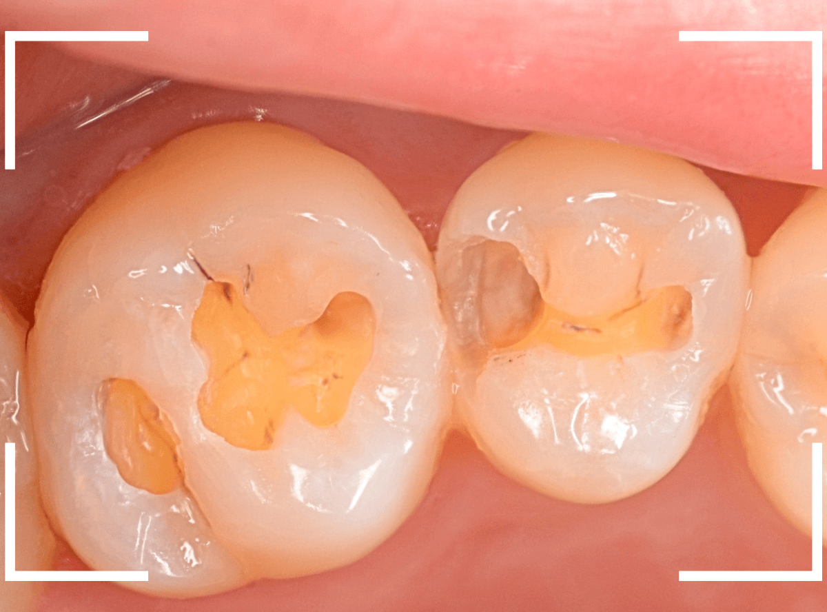 レントゲンでわかりづらい虫歯9-5