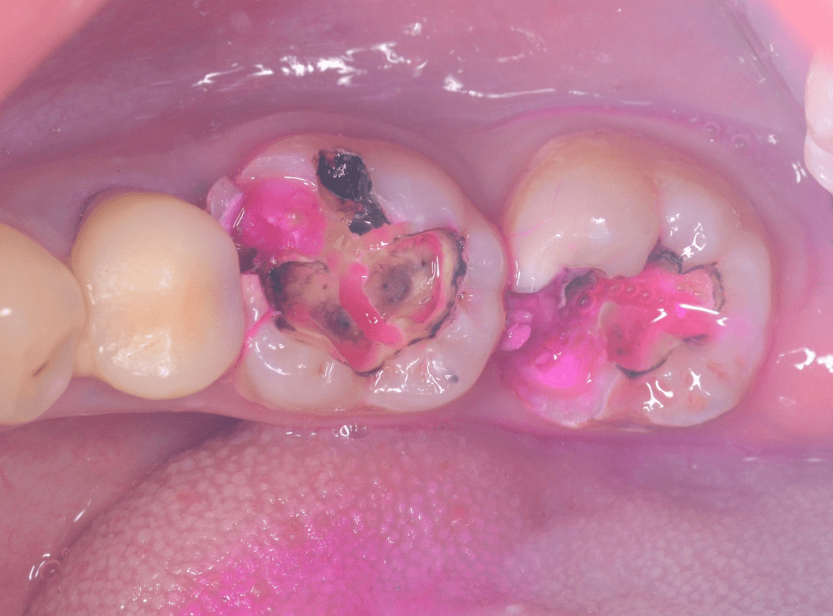 つめものの下の深い虫歯(画像)1-4