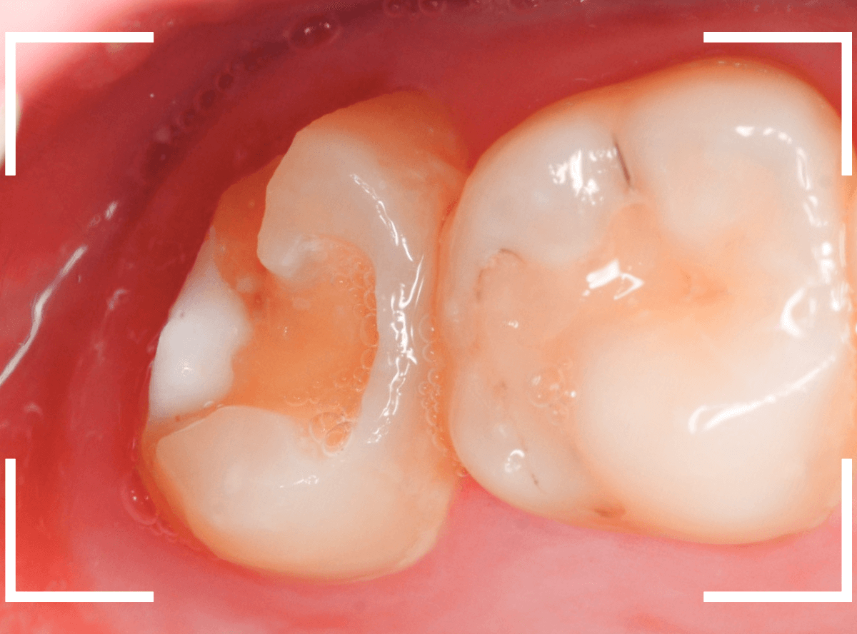 気づかないうちに深い虫歯3-7