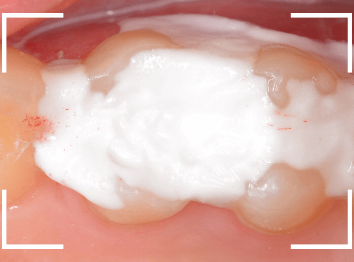歯と歯の間の虫歯9-5
