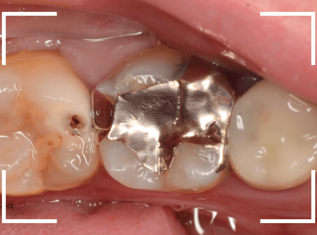 歯と歯の間の虫歯18-1