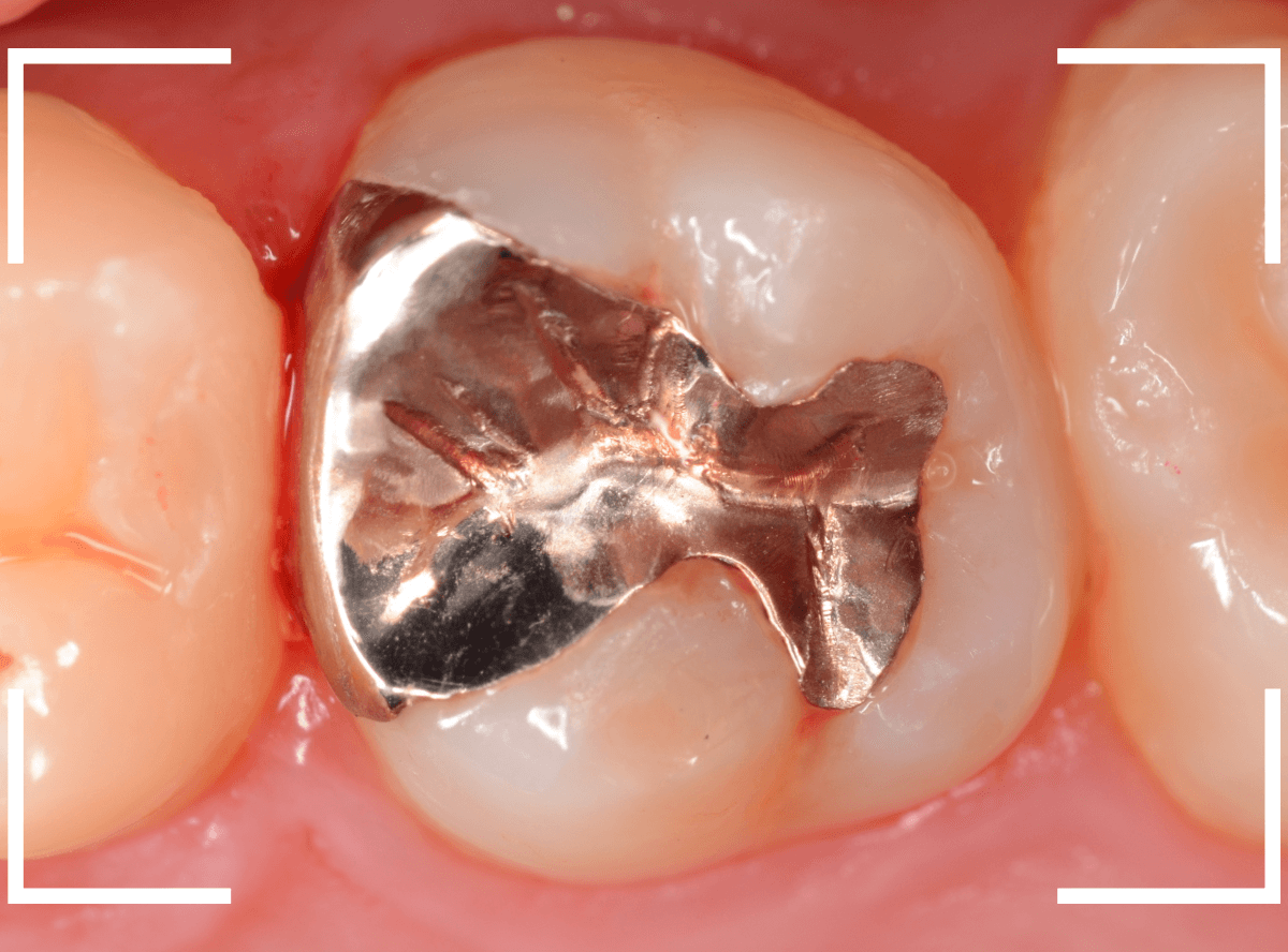 気づかないうちに深い虫歯4-7