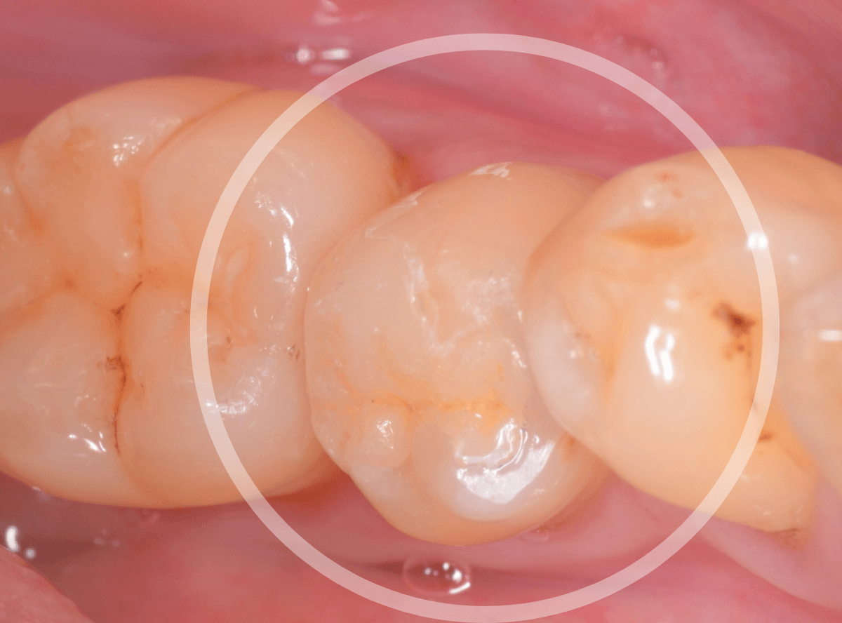 セラミック治療(インレー)1-3