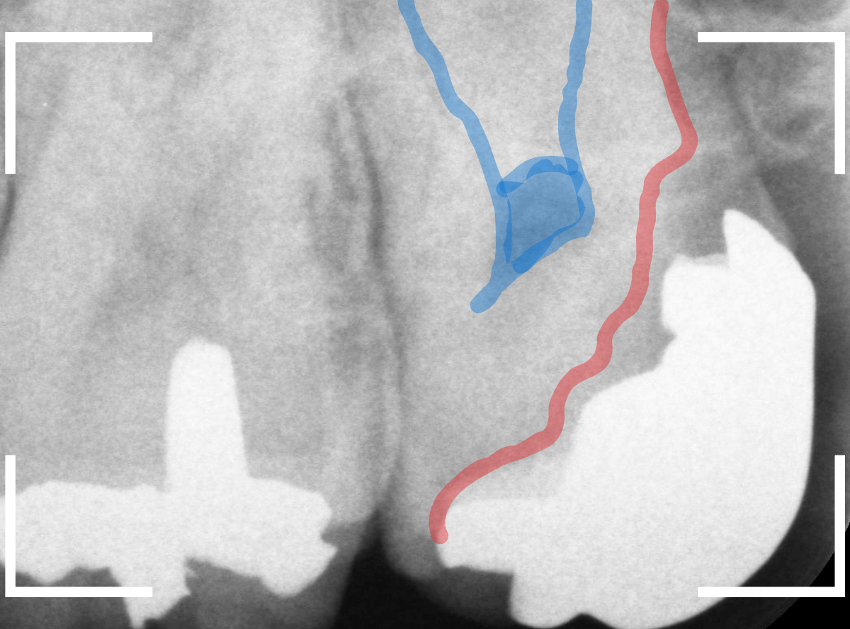 つめものの下の深い虫歯(画像)10-1